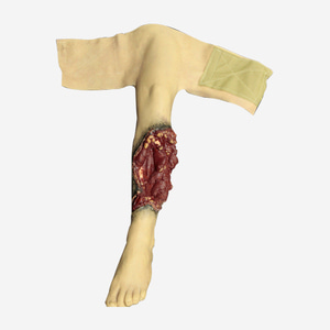 Partial Leg Amputation (Left)